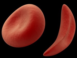 PH and Sickle Cell Disease