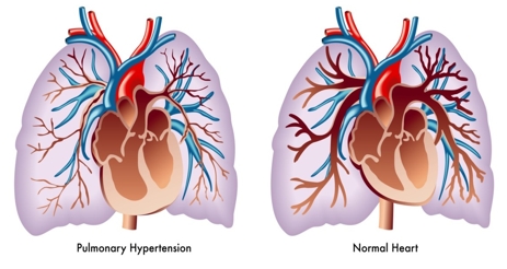 New Survey Finds People With Pulmonary Hypertension Face Serious Health, Social And Financial Impacts
