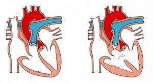 right ventricular failure in PH