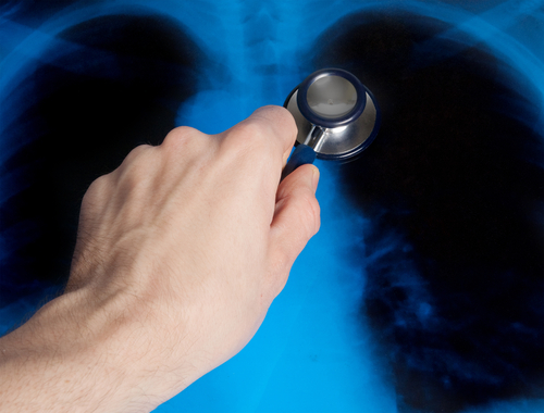 Pulmonary Hypertension and Chest X-Rays
