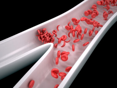 Pulmonary Hypertension and Sickle Cell Disease