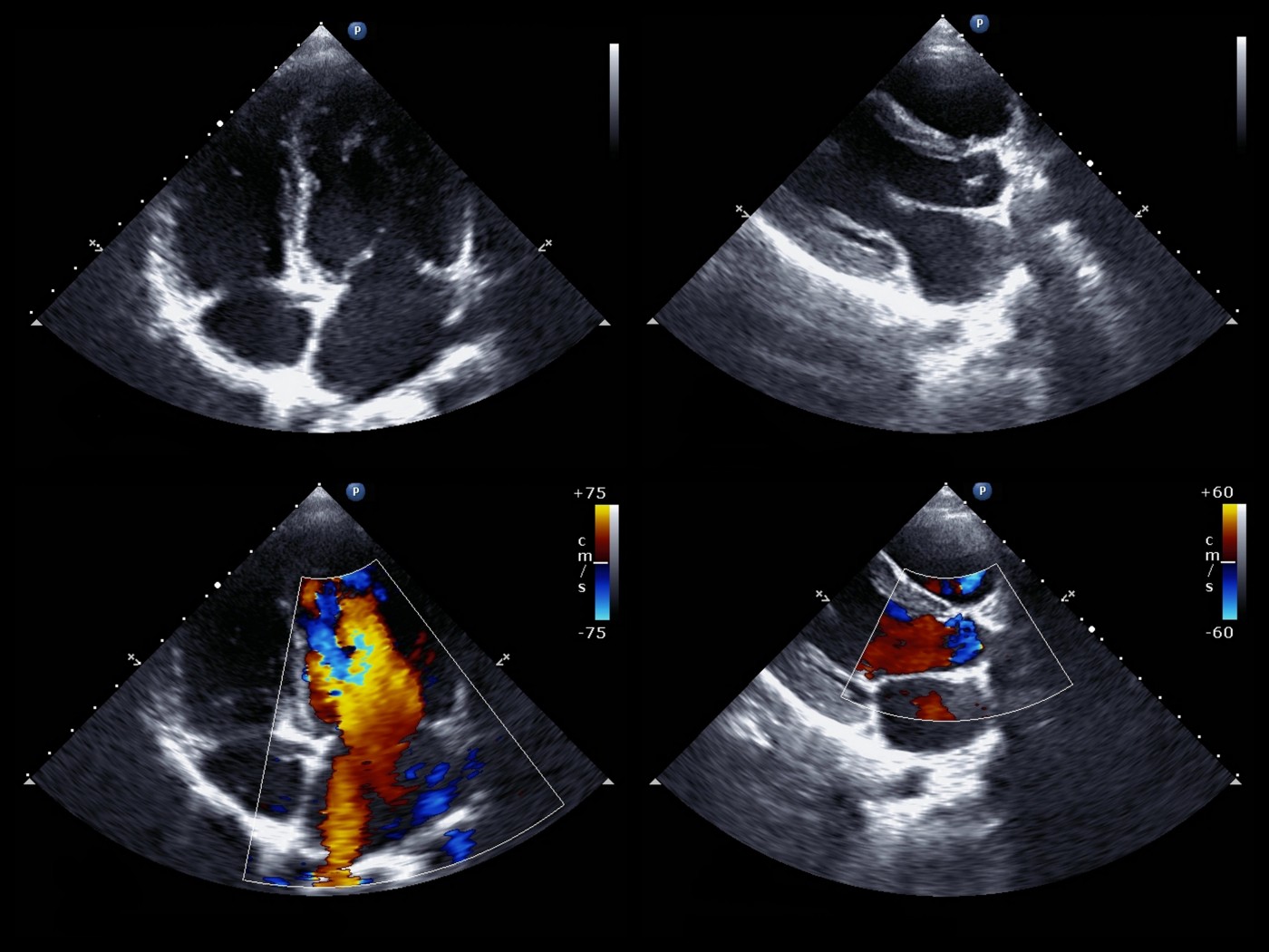 echocardiography imaging Philips