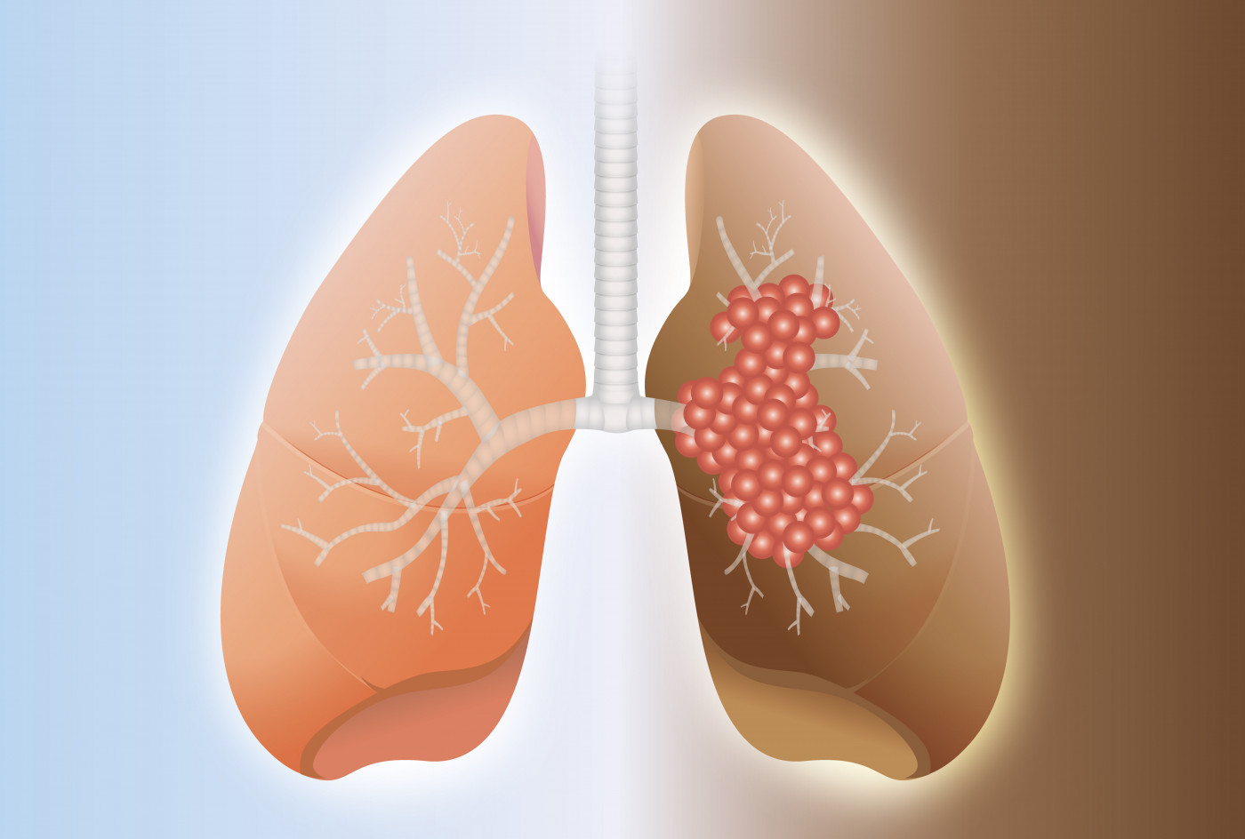 lung cancer and PAH