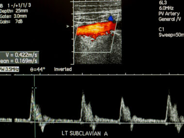 Doppler as outcome predictor