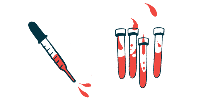 Ang-2 blood test for CTEPH treatment | Pulmonary Hypertension News | illustration of blood in vials and syringe