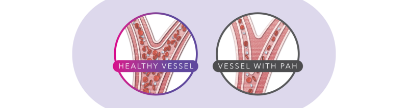 Healthy vessel versus unhealthy vessel image