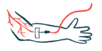 An illustration shows an arm receiving an intravenous infusion.